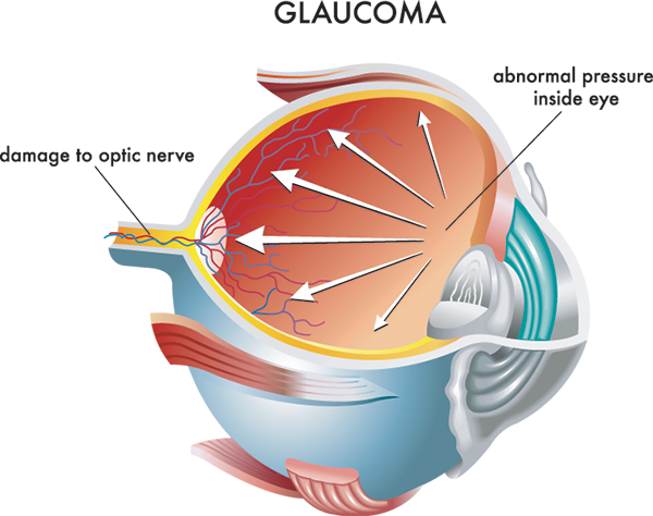 88011 Glaucoma Treatment