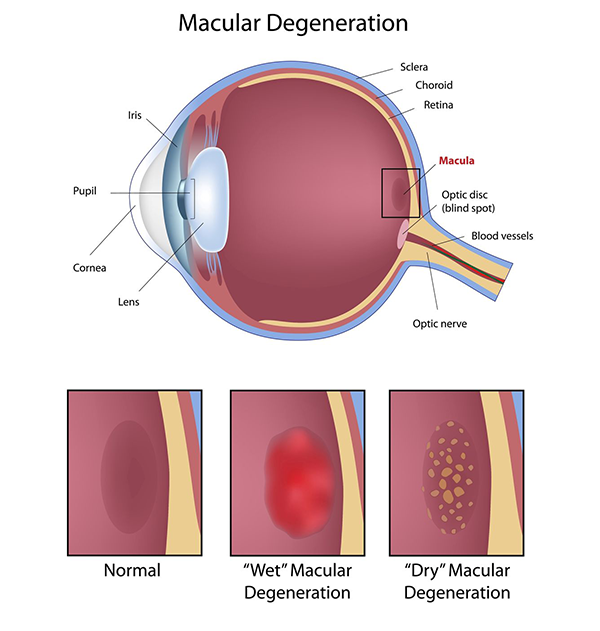 Macular Degeneration Causes in Las Cruces