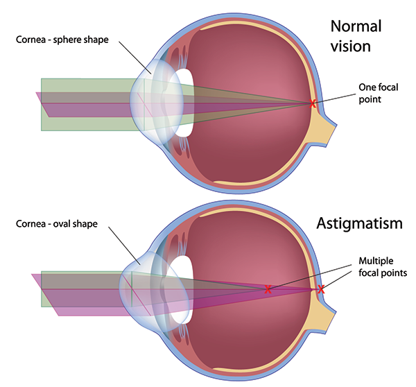 Astigmatism Treatment 88011