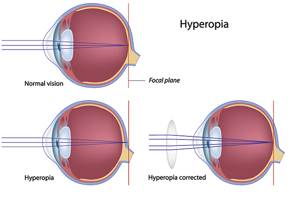 mik a látás diagnózisai hyperopia szemüveg