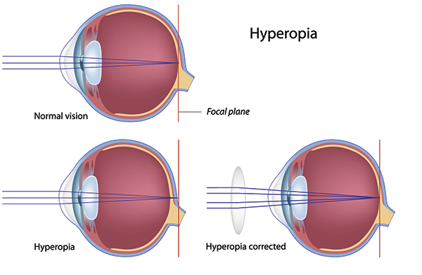 88011 Hyperopia