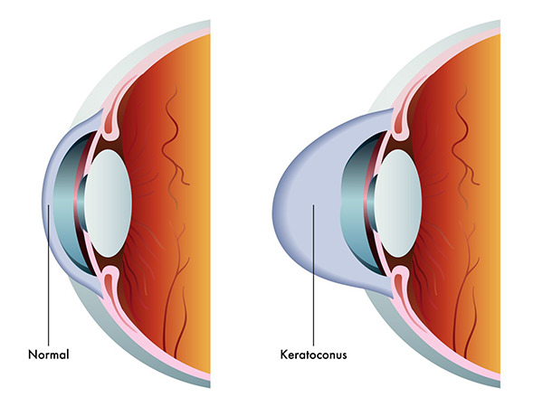 Keratoconus in Las Cruces