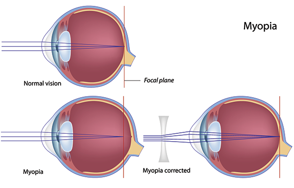 Nearsightedness Las Cruces